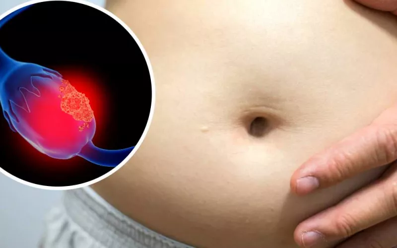 CÁNCER OVARIO