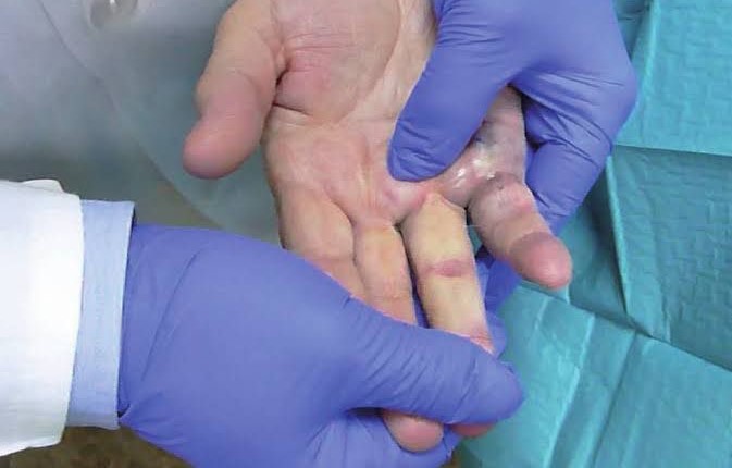 contractura de Dupuytren (1)